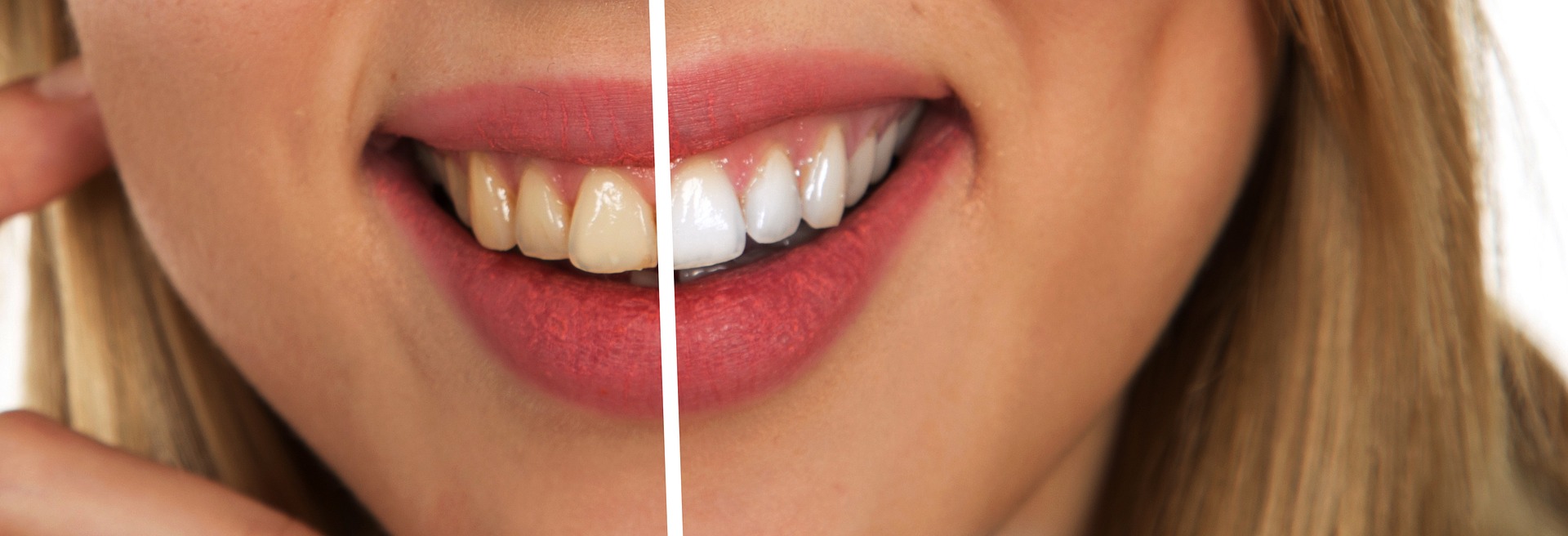 Sbiancamento Denti