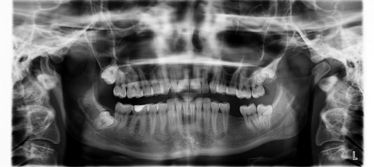 Panoramica dentale